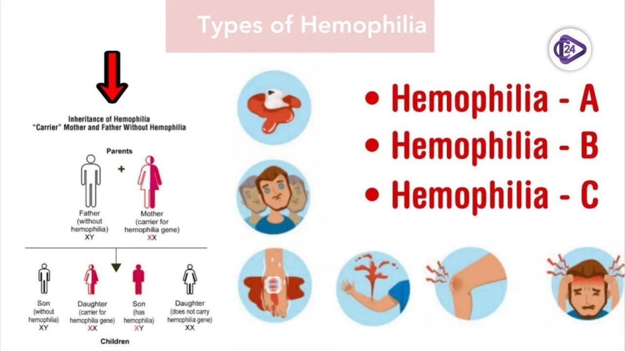 Gene Therapy for Hemophilia A: A Major Breakthrough in India