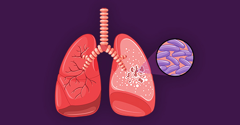 DBT Advances TB Genomic Sequencing: A Step Towards Eliminating Tuberculosis in India